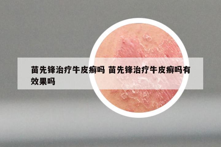 苗先锋治疗牛皮癣吗 苗先锋治疗牛皮癣吗有效果吗