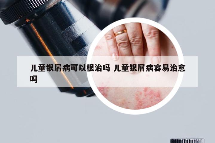 儿童银屑病可以根治吗 儿童银屑病容易治愈吗