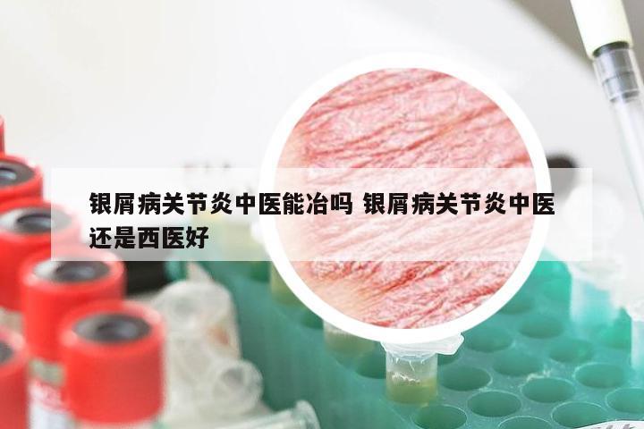 银屑病关节炎中医能冶吗 银屑病关节炎中医还是西医好