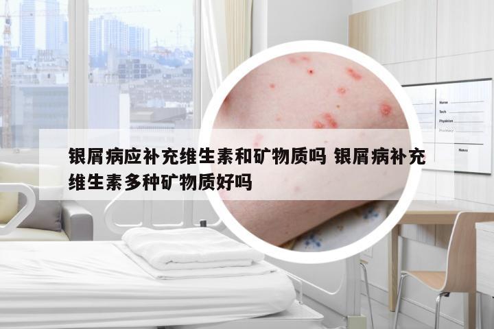 银屑病应补充维生素和矿物质吗 银屑病补充维生素多种矿物质好吗