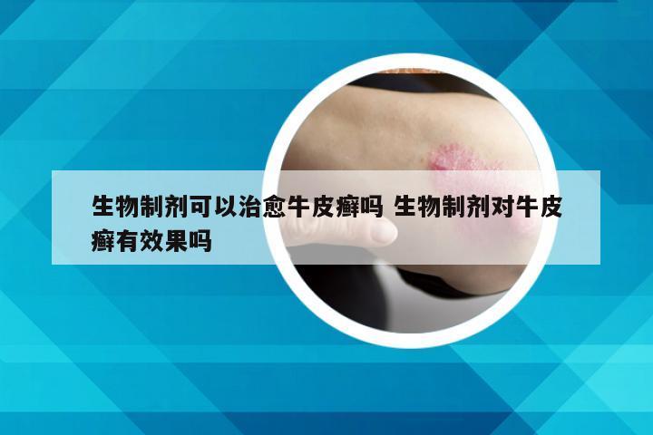 生物制剂可以治愈牛皮癣吗 生物制剂对牛皮癣有效果吗