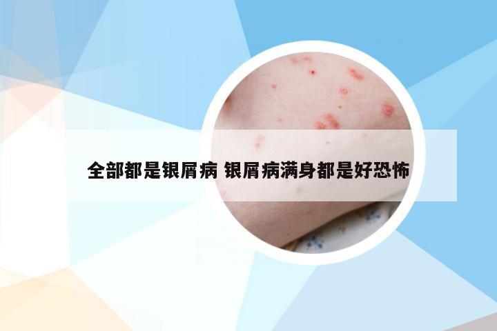 全部都是银屑病 银屑病满身都是好恐怖