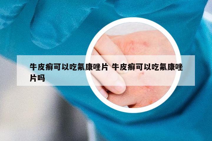 牛皮癣可以吃氟康唑片 牛皮癣可以吃氟康唑片吗