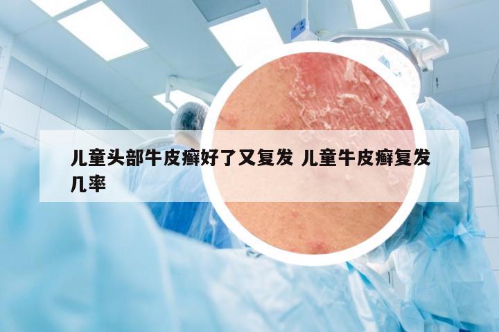 儿童头部牛皮癣好了又复发 儿童牛皮癣复发几率