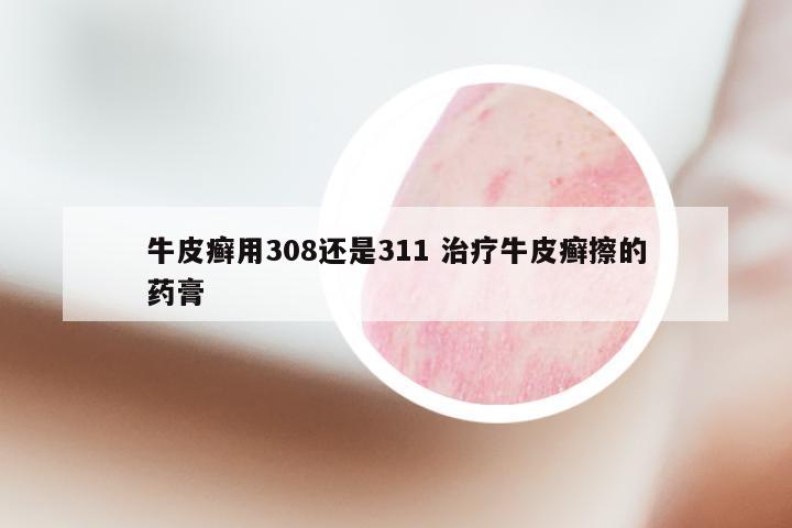 牛皮癣用308还是311 治疗牛皮癣擦的药膏