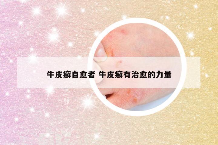 牛皮癣自愈者 牛皮癣有治愈的力量