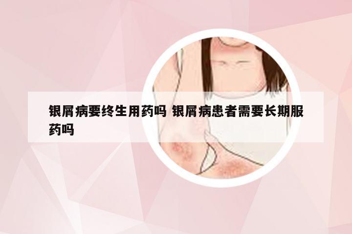 银屑病要终生用药吗 银屑病患者需要长期服药吗