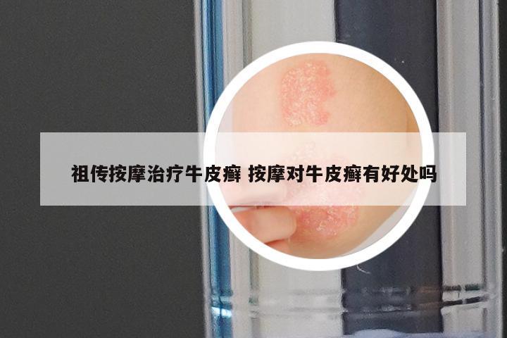 祖传按摩治疗牛皮癣 按摩对牛皮癣有好处吗