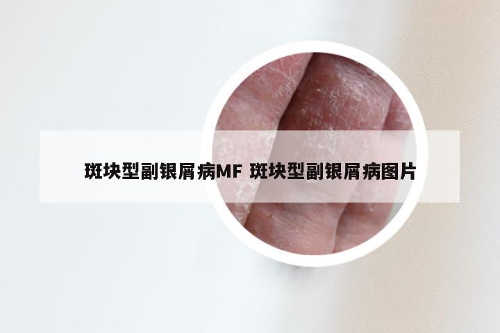 斑块型副银屑病MF 斑块型副银屑病图片