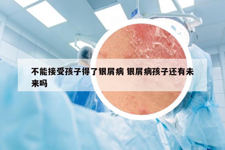 不能接受孩子得了银屑病 银屑病孩子还有未来吗