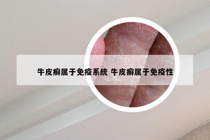牛皮癣属于免疫系统 牛皮癣属于免疫性