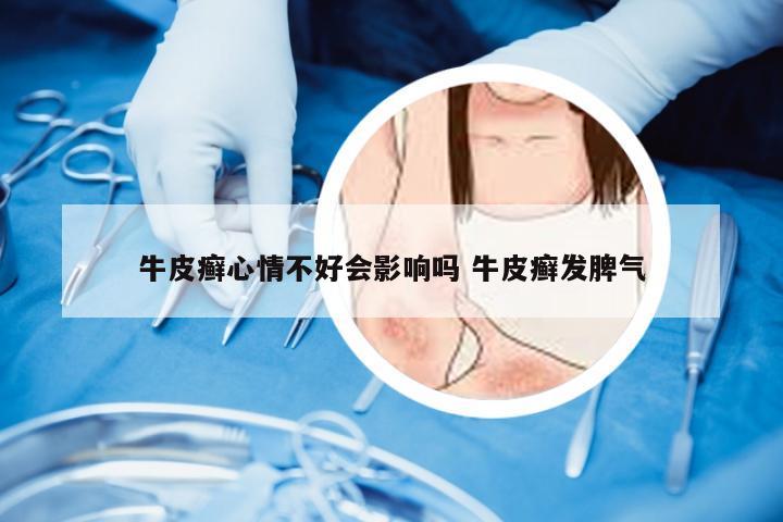 牛皮癣心情不好会影响吗 牛皮癣发脾气