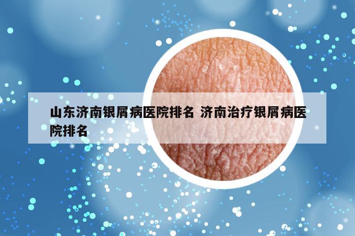 山东济南银屑病医院排名 济南治疗银屑病医院排名