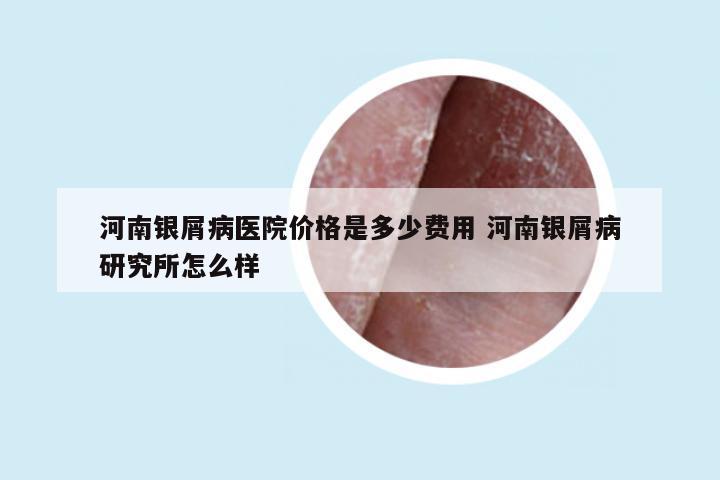 河南银屑病医院价格是多少费用 河南银屑病研究所怎么样