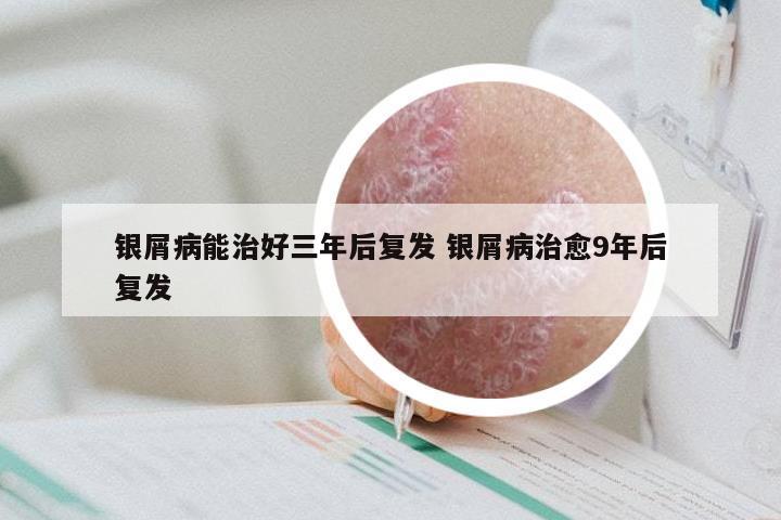 银屑病能治好三年后复发 银屑病治愈9年后复发