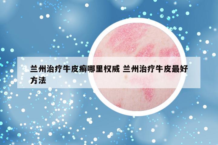 兰州治疗牛皮癣哪里权威 兰州治疗牛皮最好方法
