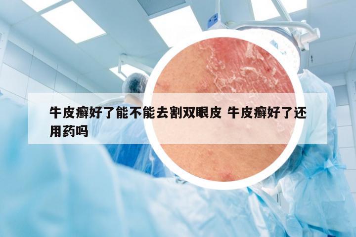 牛皮癣好了能不能去割双眼皮 牛皮癣好了还用药吗