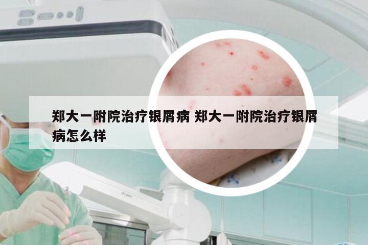 郑大一附院治疗银屑病 郑大一附院治疗银屑病怎么样