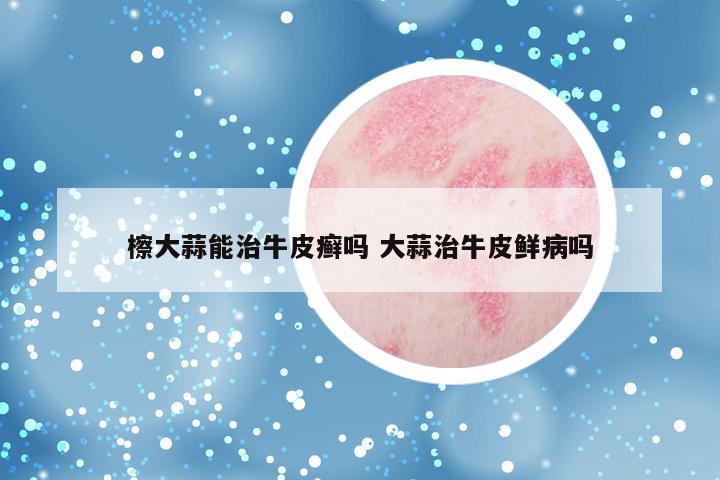 檫大蒜能治牛皮癣吗 大蒜治牛皮鲜病吗