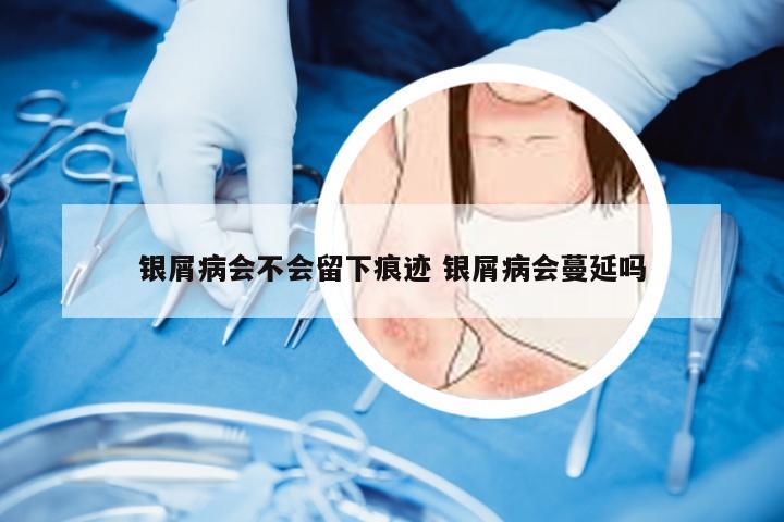 银屑病会不会留下痕迹 银屑病会蔓延吗