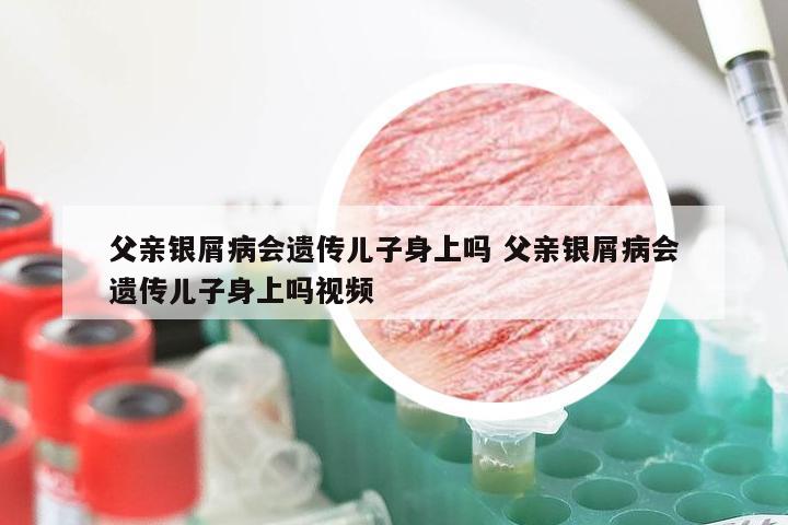 父亲银屑病会遗传儿子身上吗 父亲银屑病会遗传儿子身上吗视频