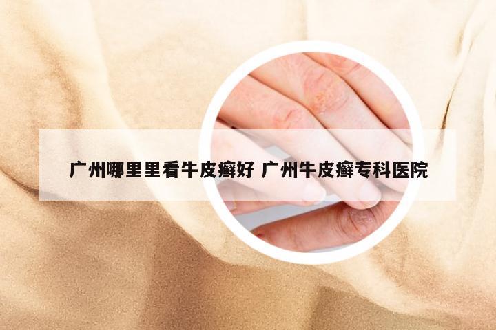广州哪里里看牛皮癣好 广州牛皮癣专科医院