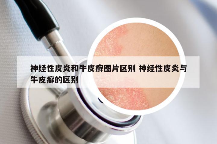 神经性皮炎和牛皮癣图片区别 神经性皮炎与牛皮癣的区别