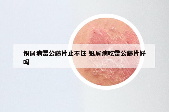 银屑病雷公藤片止不住 银屑病吃雷公藤片好吗