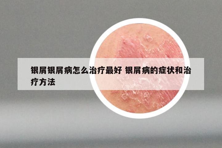 银屑银屑病怎么治疗最好 银屑病的症状和治疗方法
