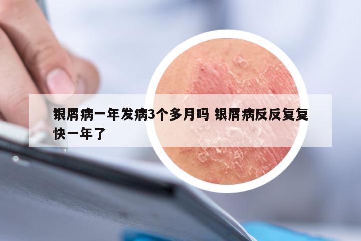 银屑病一年发病3个多月吗 银屑病反反复复快一年了