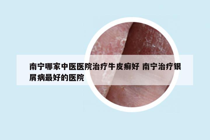 南宁哪家中医医院治疗牛皮癣好 南宁治疗银屑病最好的医院