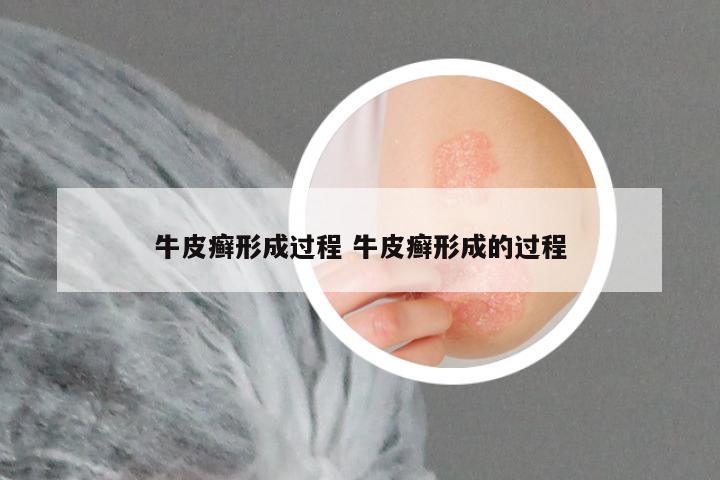 牛皮癣形成过程 牛皮癣形成的过程