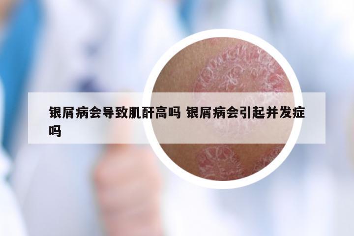 银屑病会导致肌酐高吗 银屑病会引起并发症吗