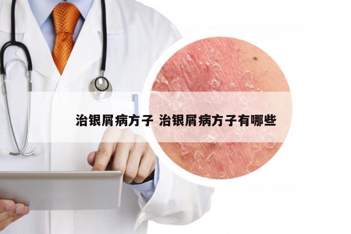 治银屑病方子 治银屑病方子有哪些