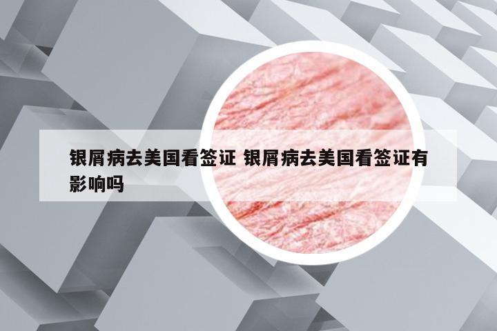 银屑病去美国看签证 银屑病去美国看签证有影响吗
