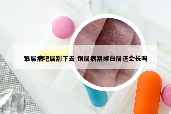 银屑病吧屑刮下去 银屑病刮掉白屑还会长吗