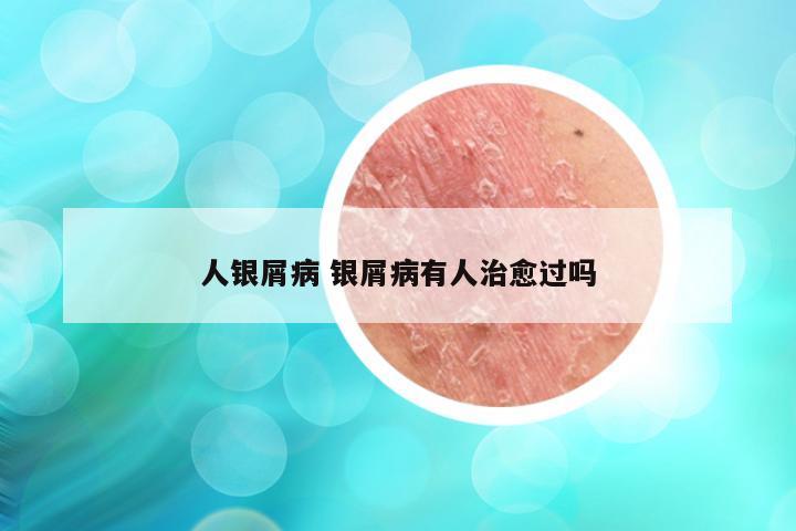 人银屑病 银屑病有人治愈过吗