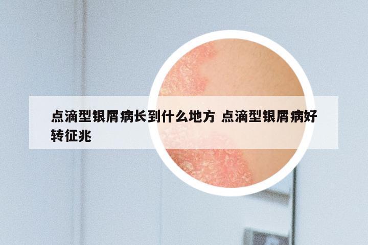 点滴型银屑病长到什么地方 点滴型银屑病好转征兆