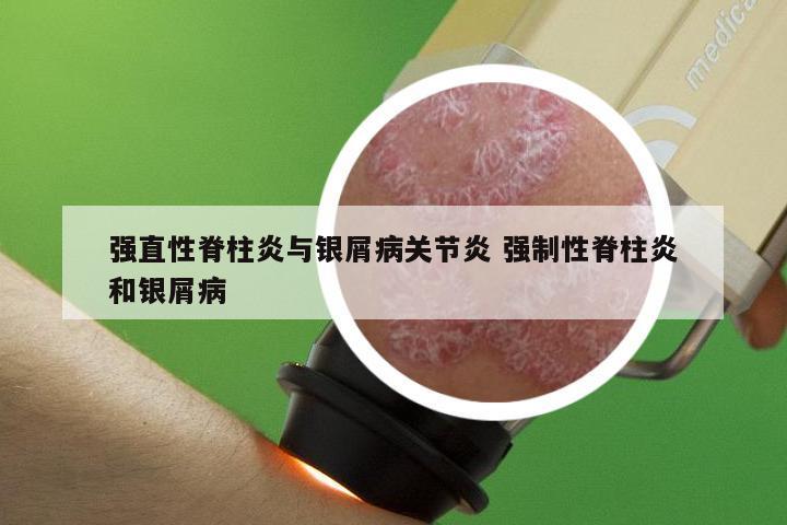 强直性脊柱炎与银屑病关节炎 强制性脊柱炎和银屑病