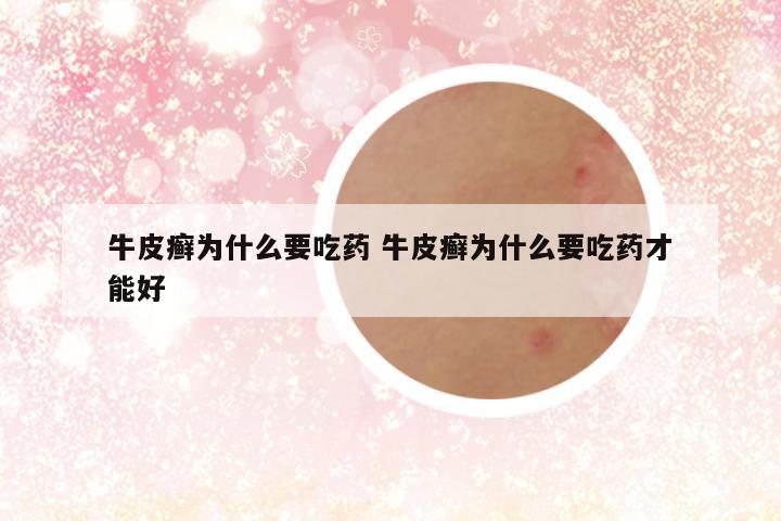 牛皮癣为什么要吃药 牛皮癣为什么要吃药才能好