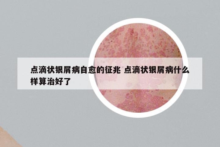 点滴状银屑病自愈的征兆 点滴状银屑病什么样算治好了