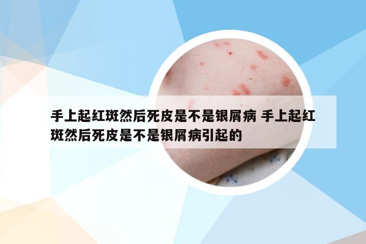 手上起红斑然后死皮是不是银屑病 手上起红斑然后死皮是不是银屑病引起的