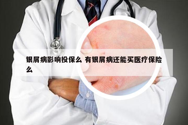 银屑病影响投保么 有银屑病还能买医疗保险么