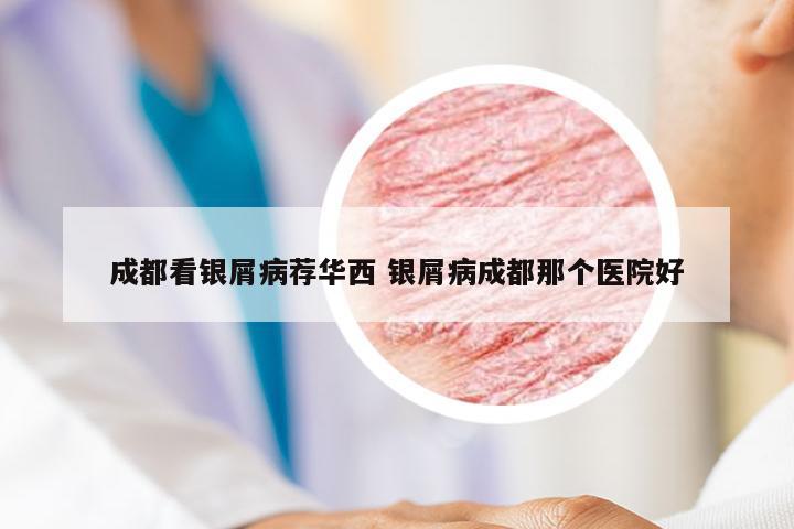 成都看银屑病荐华西 银屑病成都那个医院好