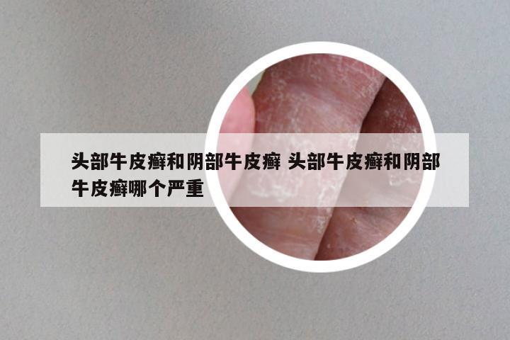 头部牛皮癣和阴部牛皮癣 头部牛皮癣和阴部牛皮癣哪个严重