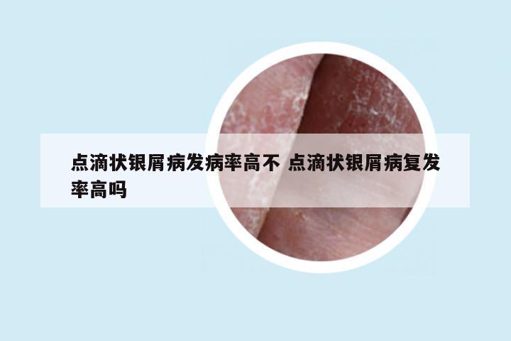 点滴状银屑病发病率高不 点滴状银屑病复发率高吗