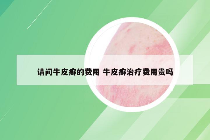 请问牛皮癣的费用 牛皮癣治疗费用贵吗