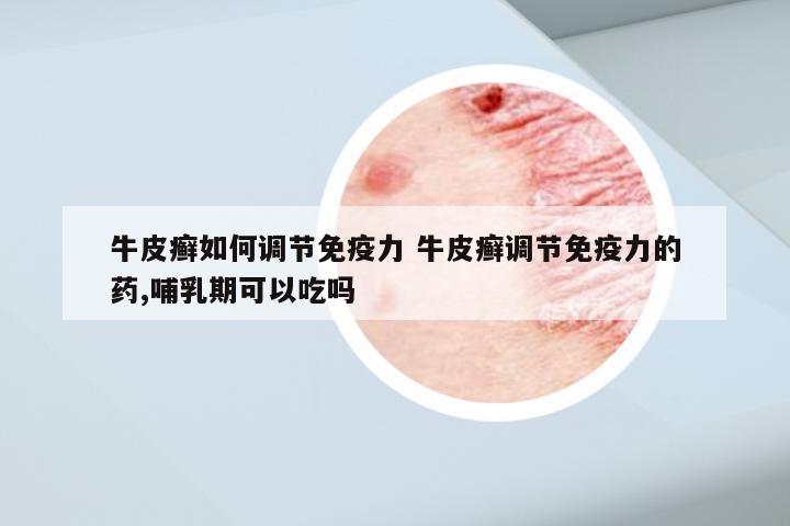 牛皮癣如何调节免疫力 牛皮癣调节免疫力的药,哺乳期可以吃吗