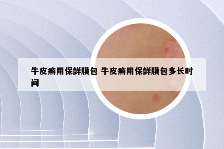 牛皮癣用保鲜膜包 牛皮癣用保鲜膜包多长时间