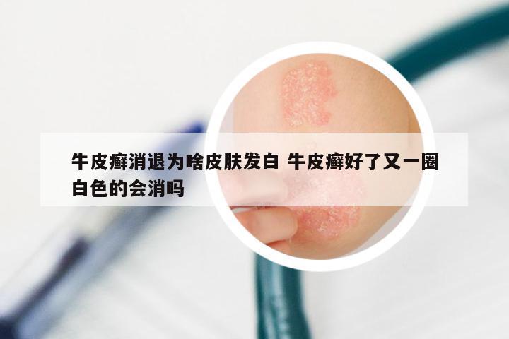 牛皮癣消退为啥皮肤发白 牛皮癣好了又一圈白色的会消吗